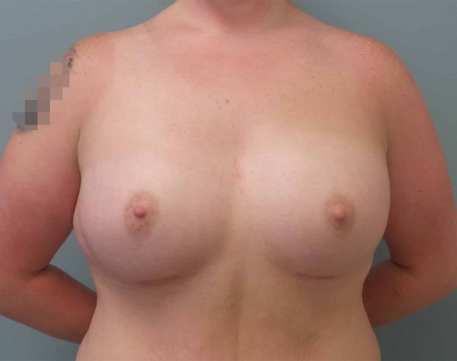 After Image: Breast Augmentation - front