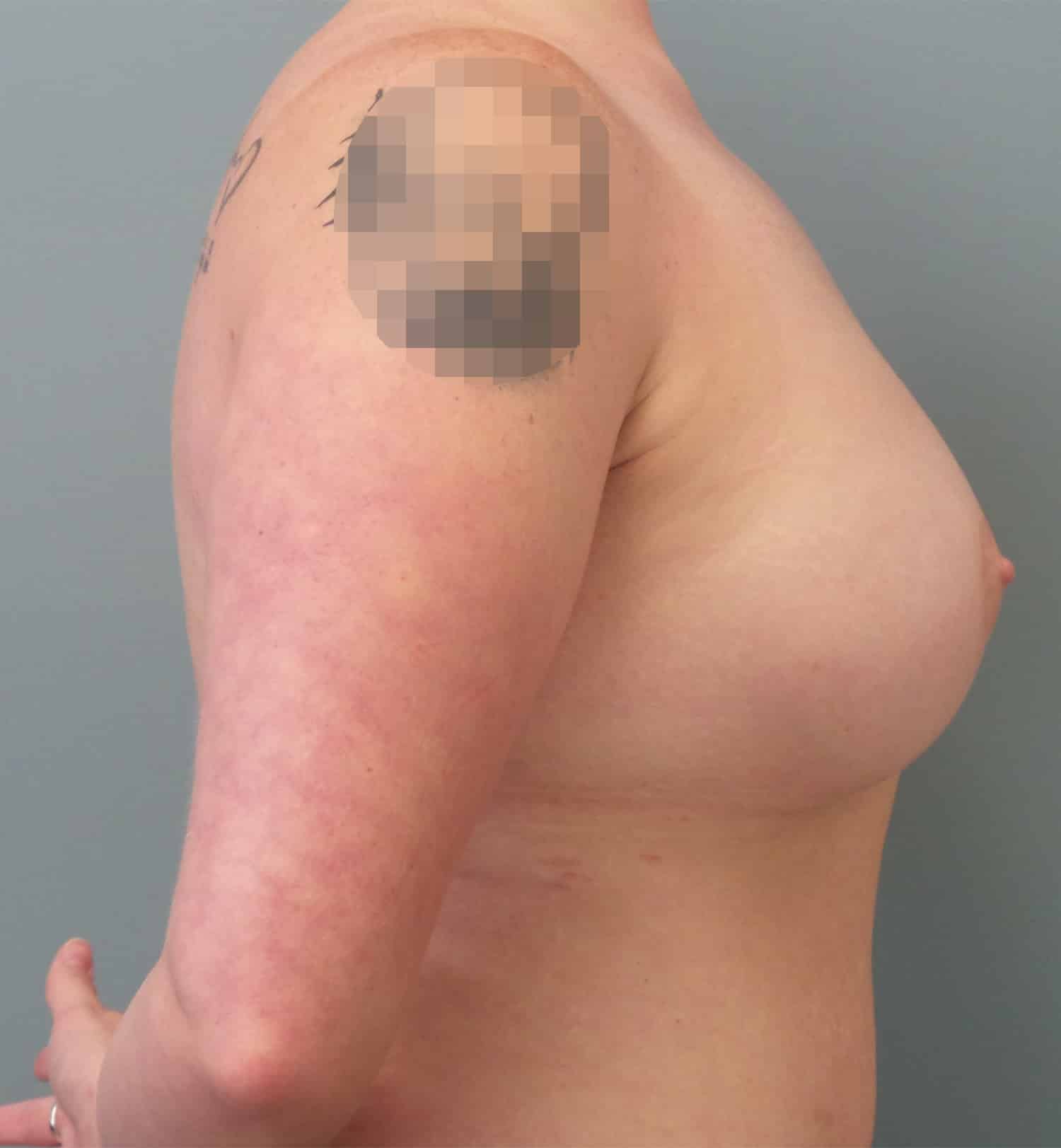 After Image: Breast Augmentation - right-side