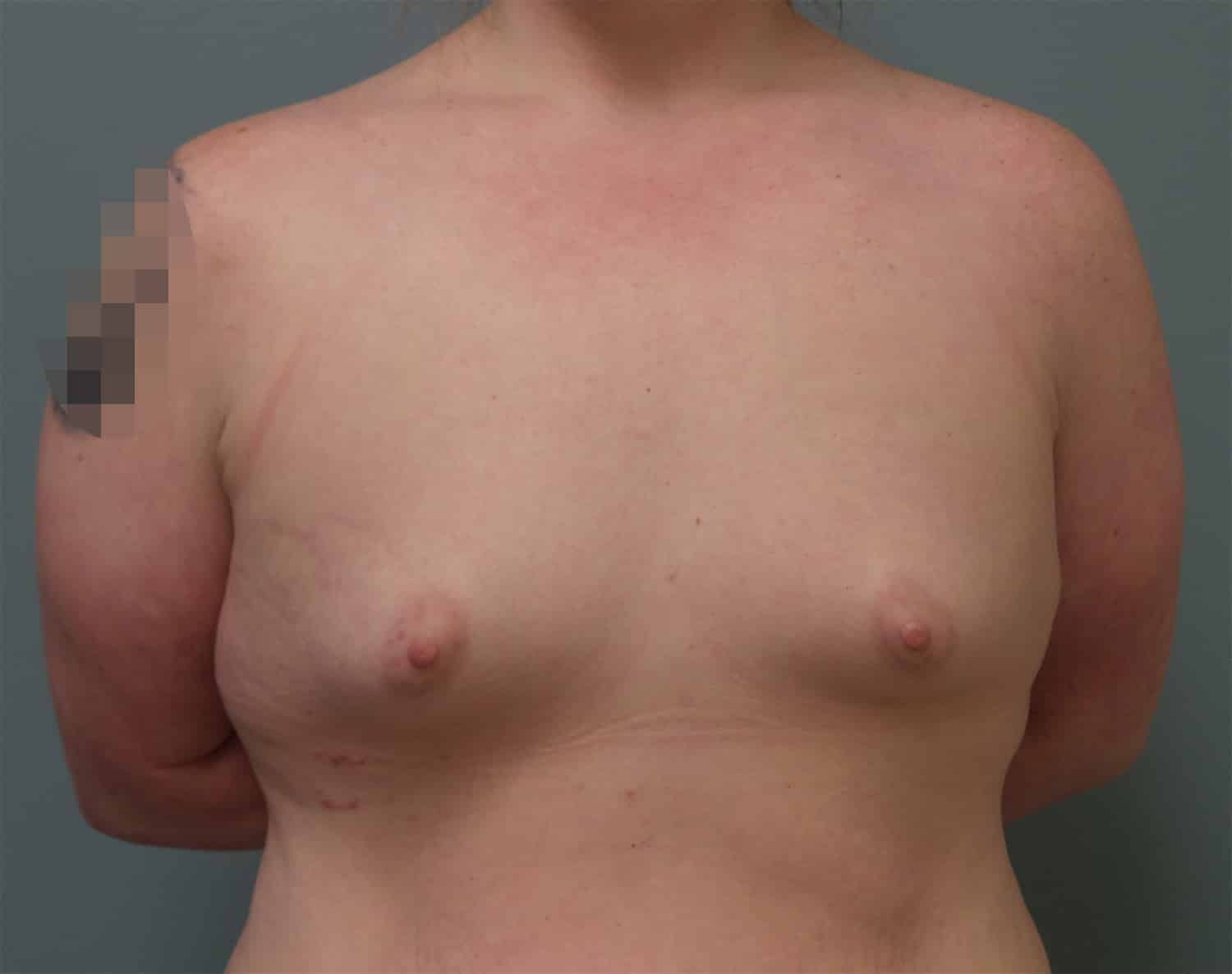 Before Image: Breast Augmentation - front