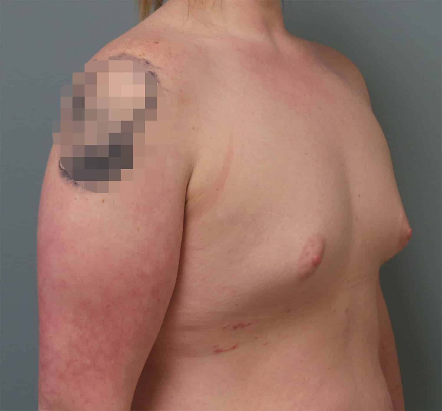Before Image: Breast Augmentation - right-front-oblique