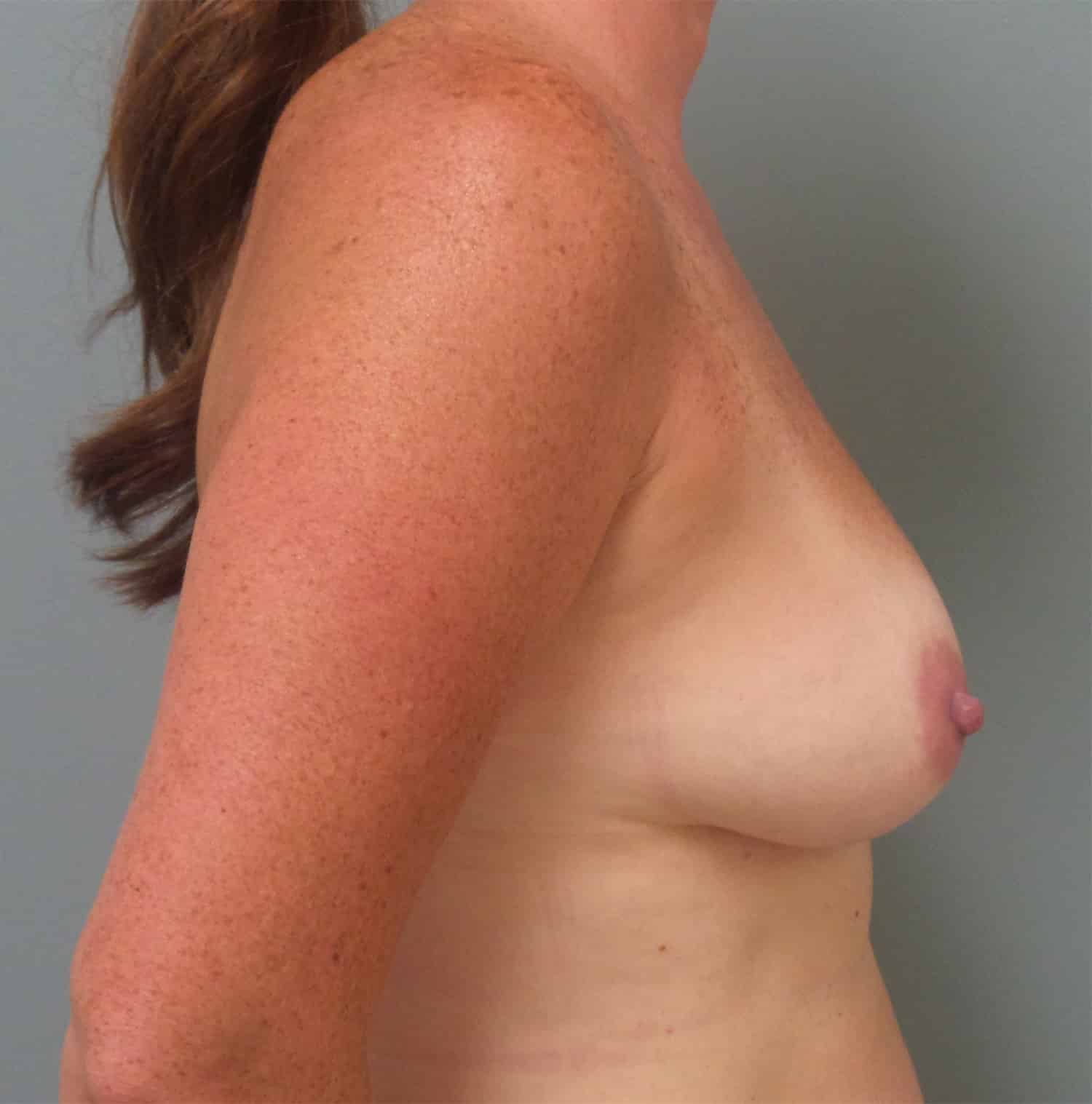 Before Image: Breast Lift - right-side